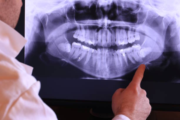 Best Emergency Wisdom Teeth Removal in State College, PA