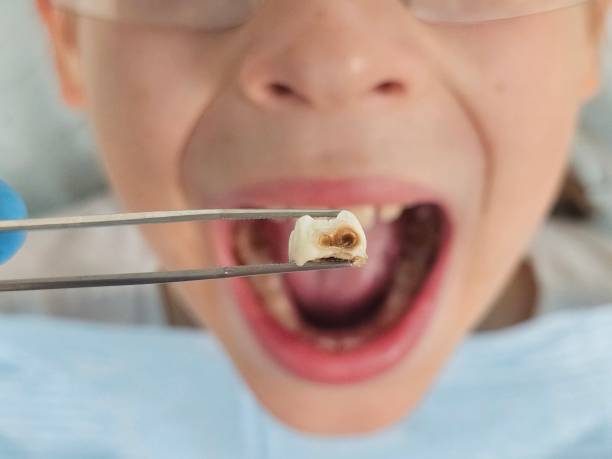 Best Emergency Treatment for Toothache in State College, PA